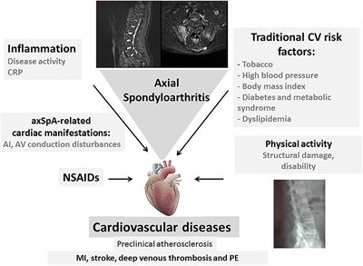 Frontiers | The Risk of Cardiovascular Diseases in Axial